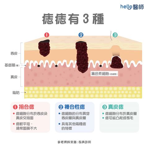 痣多的原因|為什麼臉上的痣越來越多？皮膚科醫師解析長痣原因、。